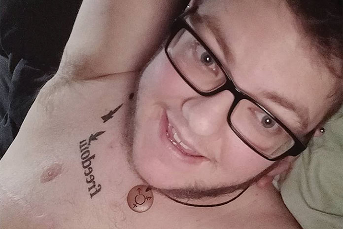 Top Surgery