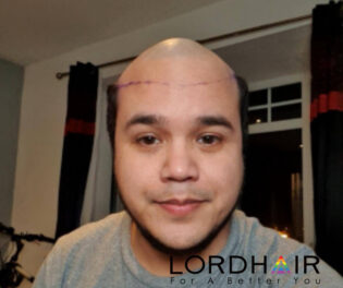 Lordhair hair sytem